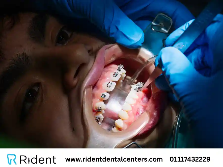 مراحل تقويم الاسنان| أهم النصائح